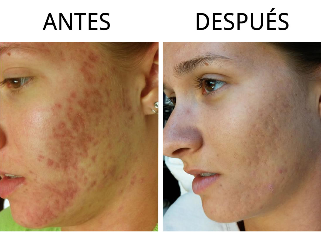 abcde