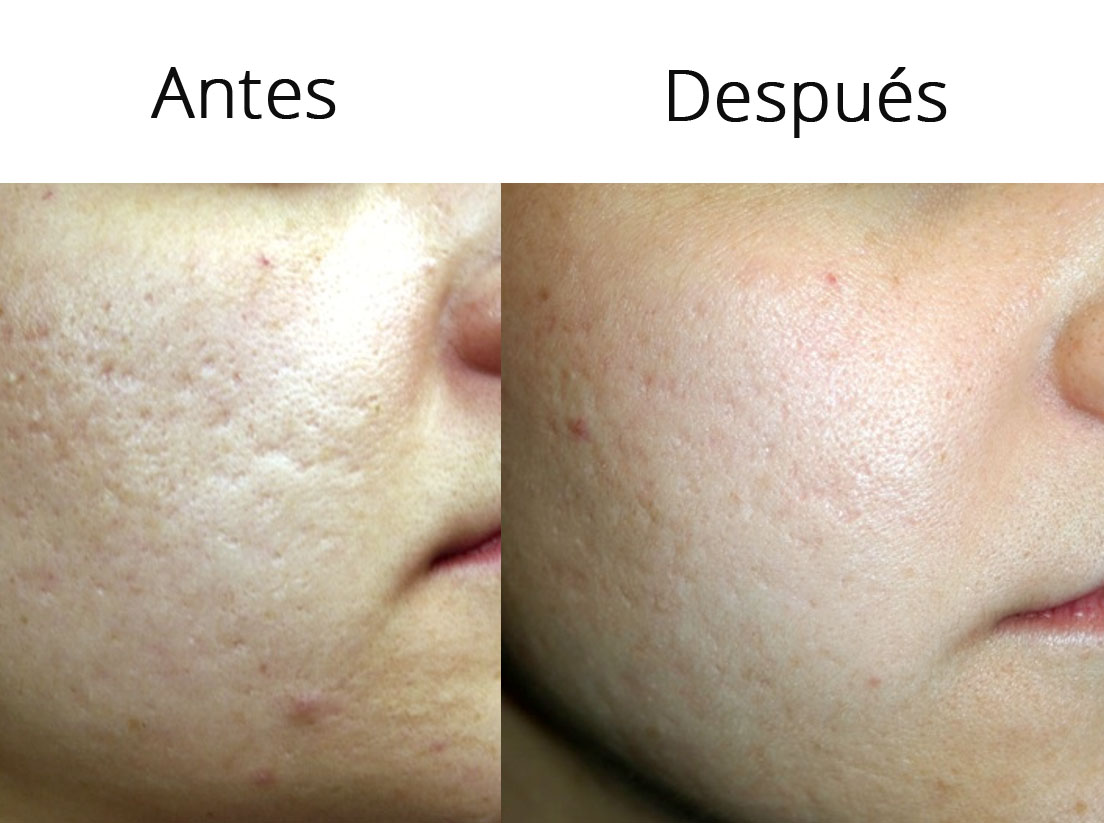 abcde