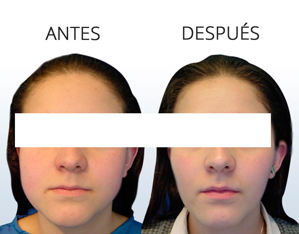 abcde